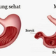 Illustration for article titled Obat Maag Herbal Paling Ampuhem/em